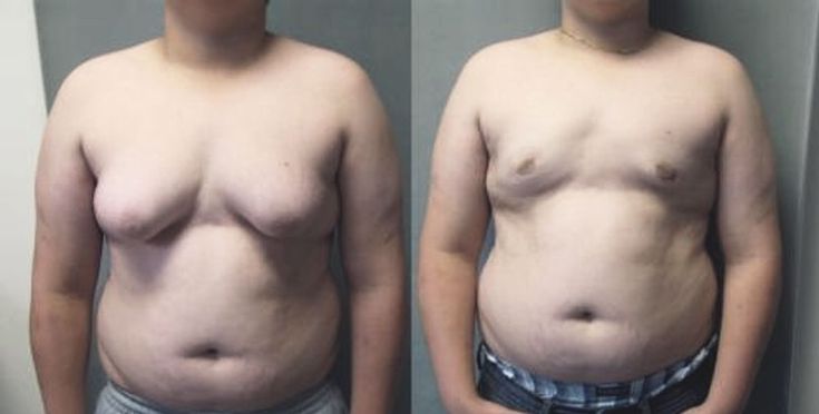 عملية التثدي