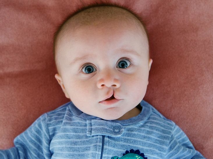 الشفاه الأرنبية وشق سقف الحلق